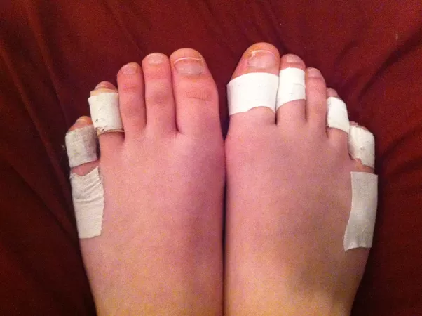 How Can I Stop Blisters En Pointe?